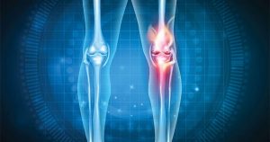 Osteopathy for Arthritis Pain